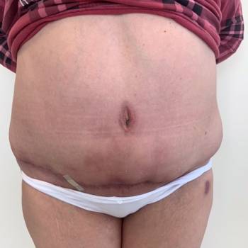 Miesiąc po operacji. Plastyka brzucha - abdominoplastyka.